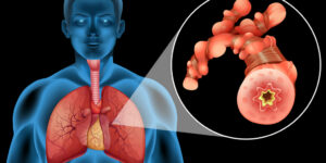 भारत में युवाओं के फेफड़े हो रहे खराब। 